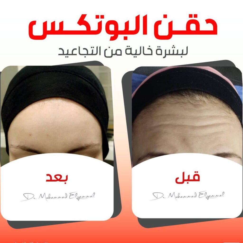 نتيجة البوتوكس والفيلر - نتائج فورية