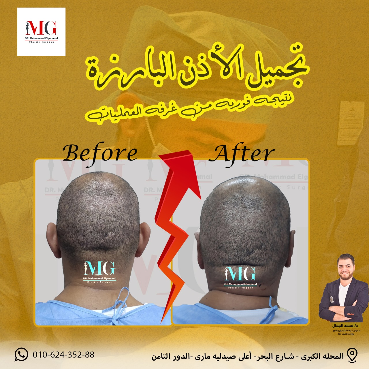 عمليات تجميل الأذن والوجه - قبل وبعد