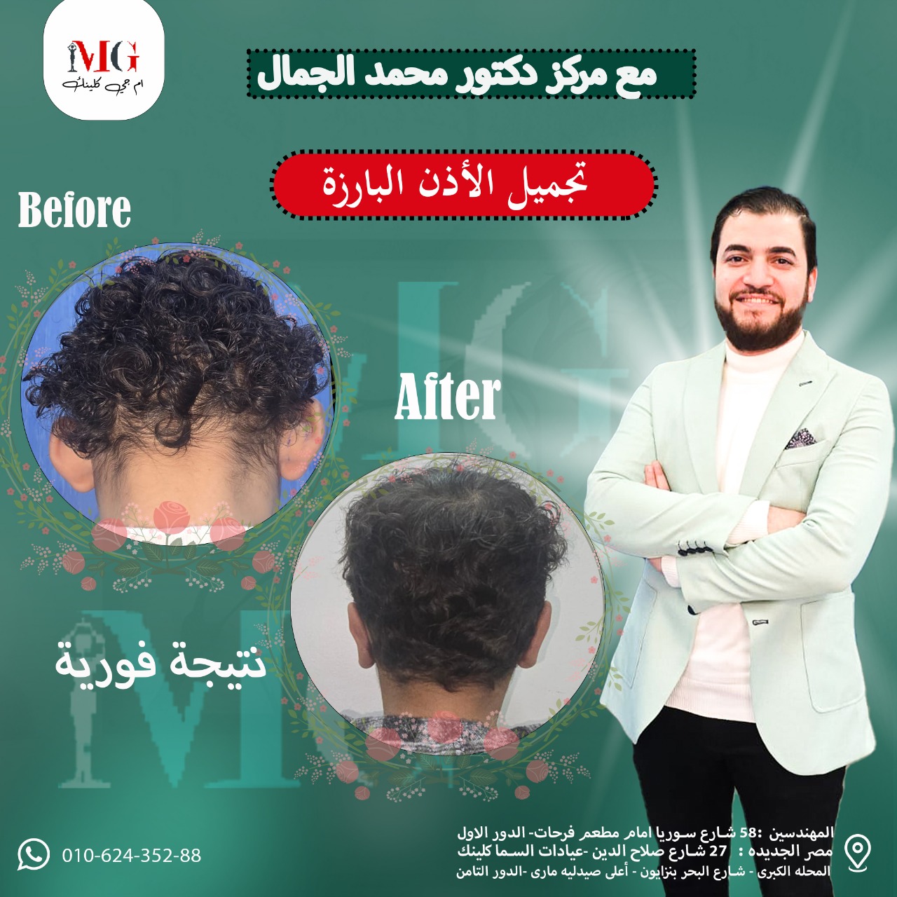 نتيجة تجميل الأذن — تصحيح بارز