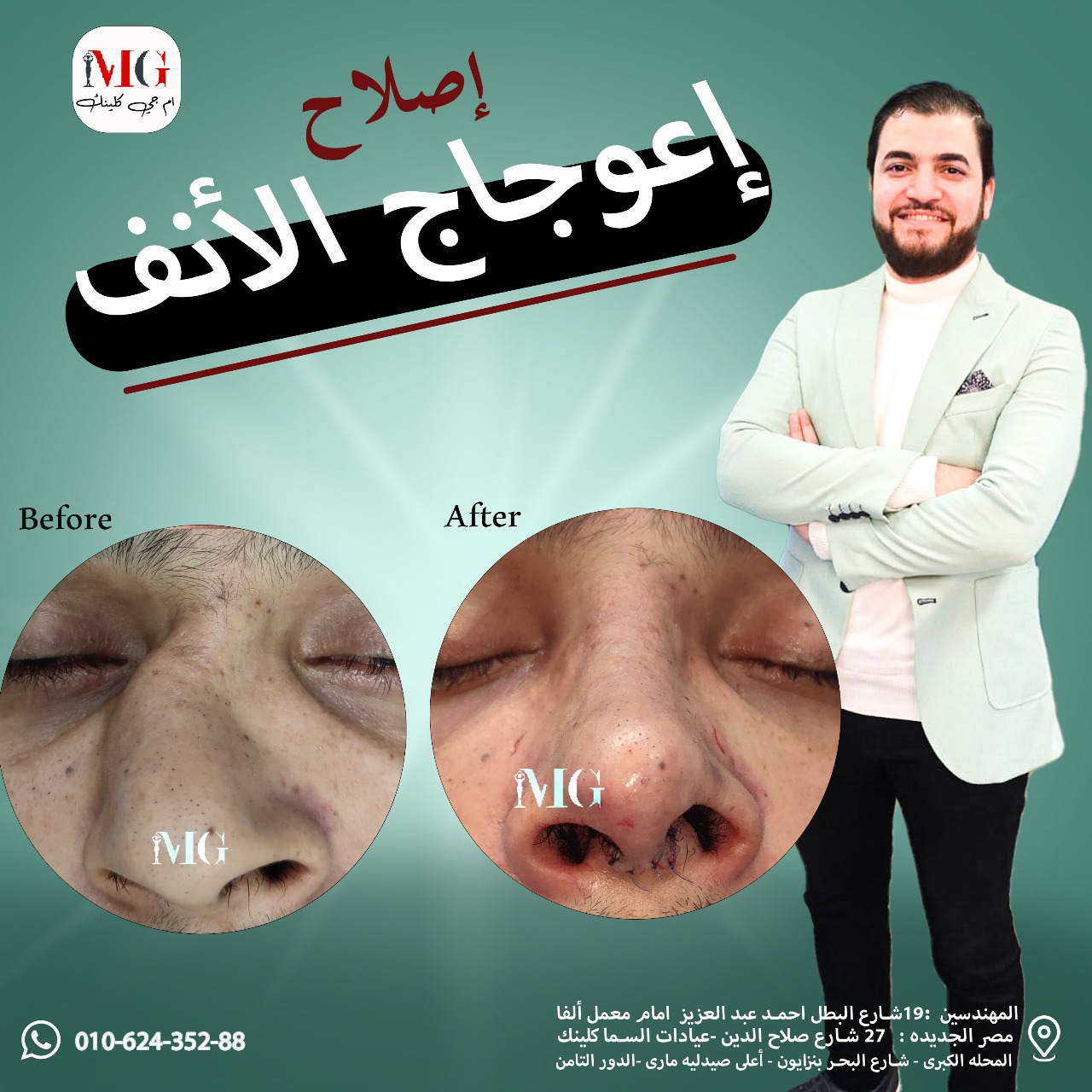نتيجة تجميل الأنف — قبل وبعد
