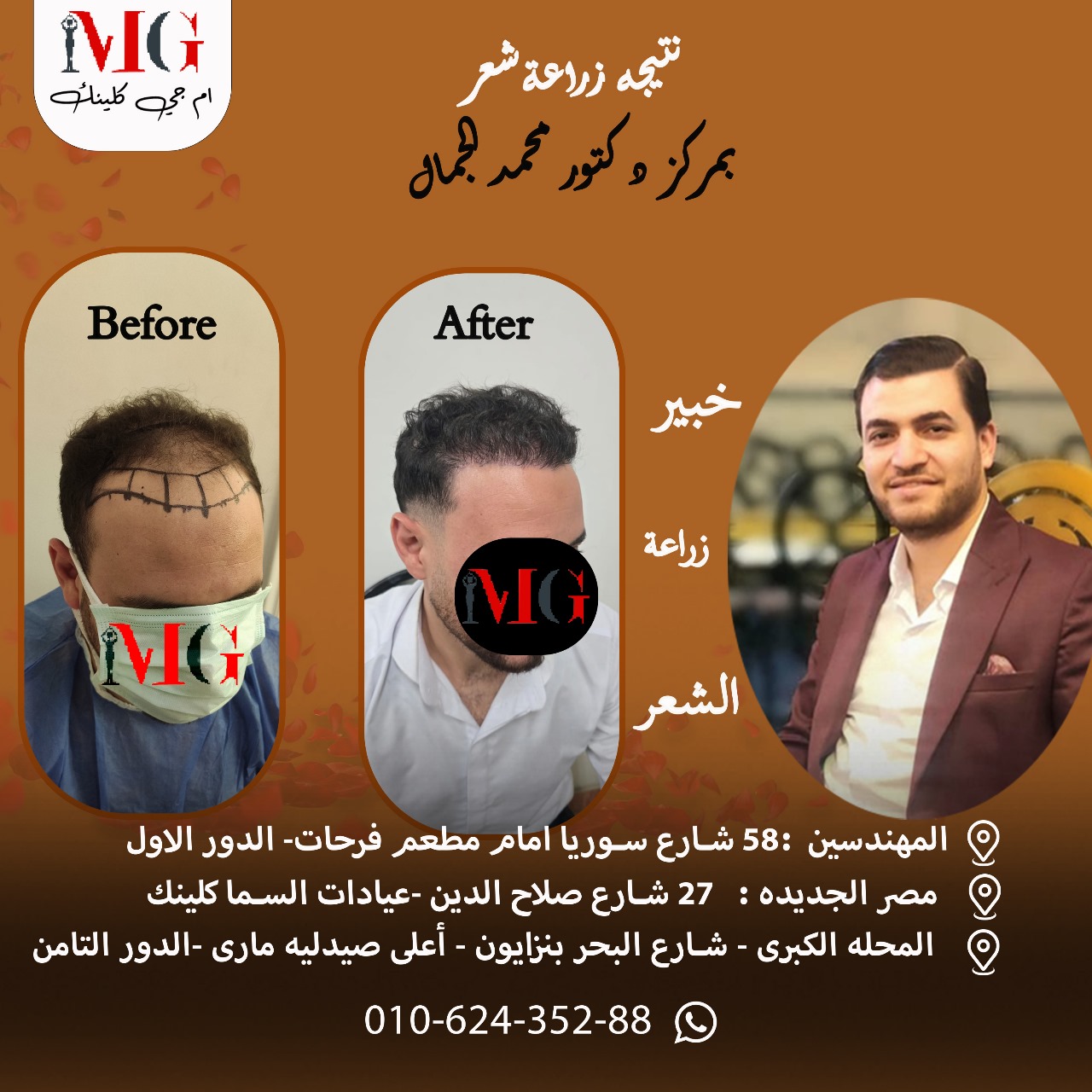 نتيجة زراعة شعر — خط الشعر الطبيعي
